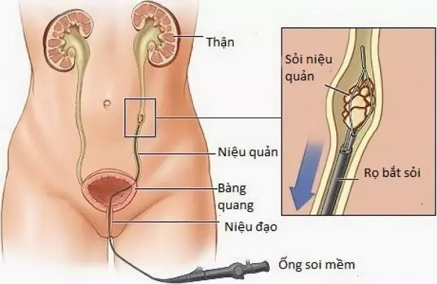 Tan-soi-nieu-quan-nguoc-dong-bang-laser-duoc-ap-dung-rong-rai (1).webp
